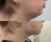 3 days post op from double chin liposuction and a chin implant. from chin powa