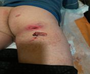 Photos from Russian doctors.(If you are easily disgusted don&#39;t tell me that I didn&#39;t warn you the finger of a Russian soldier became shrapnel and hit a different Russian soldier in the butt more info in the comments) from russian casti