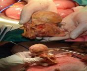 Clinical case of a 77-year-old woman with lithopedion - a mummified fetus that died in the uterus or abdominal cavity, which then underwent calcification. Presumably, the fossilized fetus was in the pelvic cavity for about 40 years from 40 old woman with 13