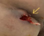 After fistula surgery, I have a small lump at my anus. Everytime I poop, feel like stool doesnt come all out. Please help!!! I am scared. from lump com