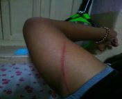 Got scratched by a twig when getting down from a Mango tree from mango tree desi girl fuck hr bfঅ