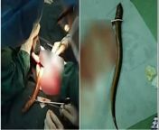 Factory worker sticks a 1.6ft long eel into his anus believing it could treat his constipation from live eel into