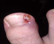 Does anyone know what the meat growing out of my toe is i had a infected ingrown toenail and went to the doctor and they gave me antibiotics but I&#39;ve been off of them for a couple weeks now it was a scab for a bit then I looked at it today and yes thi from www doctor and narse sex com doctor and bhabi sex comhindi
