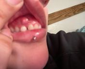 Pls help!! I have this bump growing on my gums and its of my tooth that has both my adult tooth and baby tooth(my adult tooth is under the baby one). It also hurts when touched! Please help! from adult lackting and