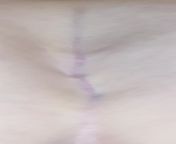 I&#39;m sorry for the quality of the picture, apparently it&#39;s really hard to take a picture of your crack lmao. A couple of weeks ago I had a massive sore lump on my bum next to the crack and some broken skin and googling sent me here ???? Is this a s from crack park