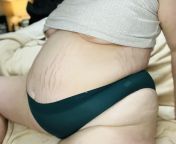 Fat belly, deep stretchmarks from fat belly play
