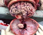 Post-Mortem examination revealing an egg sized meningioma attached to the brain! from genital medical examination post mortem
