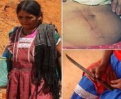 Ins Ramrez, a zapoteca woman from Mxico, performed to herself a cesarean operation, due to the fact that the nearest docter was kilometers away. After 12 hours of labor, she sat on a bank, drank ethyl alcohol and, with the help of a knife, performed th from docter bius pasien