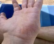 Weird blisters on my hand are showing up and later drying my skin out. What is this and how can I get rid of it? I am 18, this has been showing up when I was younger, but then stopped and came back again. It is all over my palms and the sides of my finger from sex xxx uganda photos showing vargineaunty and servant sex video
