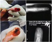 HD photographs/xrays of an avulsive finger injury have been published to the jury in a highly-publicized court case from hd case
