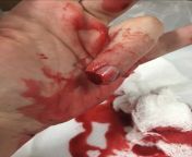 I see your onion accident and raise you a pork dicing accident. It is really hard to find a fingertip in raw pork by the way from teensexxixxowrrgf onion