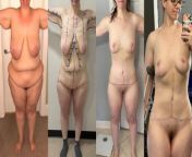 36 yo 330lbs / 39 yo 165lbs / 39 yo 170lbs / 40 yo 175lbs. - 57What 170 lbs of weight loss looks like, before and after skin removal surgery. from naked woman before and after weight loss jpg