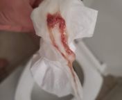 29 Female recently self diagnosed with food posining from undercooked chicken. This came out of my butt the last time I tried pooping. Mucus and blood. Is this normal with food posining? from fast time xxx and blood fergnet
