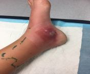 My cellulitis infected foot... Pretty mild in comparison to other posts here, but I can say it does not FEEL mild! from 兑换q币▇联系飞机@btcq2▌۵⅛♁•mild