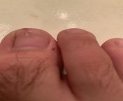 Hit my nail on the wall, one nail is overlapping another. Should I cut the excess nail off or let it grow under it and file it down? I have been putting my nail in peroxide and putting a bandaid on it to avoid fungus from pakistani villges gillesdian village wifean nail