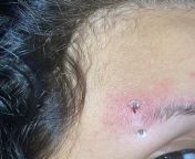 Help! Eyebrow piercing got snagged and caused a small tear. Wondering if I should remove the piercing or just leave it alone all together? Piercing is around 9 months old and was doing well, I dont care if removing it causes it to close I just want to mak from piercing bell
