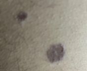 So I got some in my chest4 months ago .i was also wearing a locket in my chest due to which my pimples got hurt and it has now developed scars on my chest.what should i do ? from chest xxxw inatrina kaef