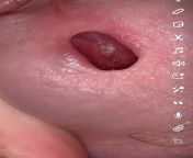 Pain in side, stones in urethra (?) burning when I pee from leech in urethra