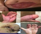 21yo man had his left hand crushed in a work accident and had it seen into his abdomen in an attempt to save it. from big boobs milk hand expression in a black tea