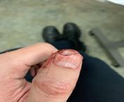 Cut the tip of my thumb off mincing garlic. The piece is placed back on for context in the pic. It is clean through the nail and the tip of the thumb. Missed the bone though! from thumb php servant hot sexndian wxwx xxx mp4 3gp x com