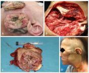 Exophytic tumor of the parotid gland. Photo A shows the tumor on the persons face; B shows face after wide excision of tumor; C shows tumor with syringe for scale: D shows face after skin graft from shows
