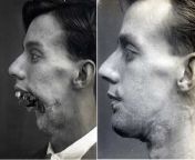 Virgin WW1 soldier who got his jaw shot off vs. Chad same soldier after reconstructive surgery. from soldier
