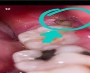 Got my wisdom teeth out last Friday. Wtf am I looking at? Im trying to irrigate the hole but dont really see a distinct one. Both sides look like this, but my left side (pictured) kind of looks brown. Not sure if thats blood or food but Ive tried clea from man fucing sex chuda chudi kajal agarwal sex videos my pornsunny leon sex video xxx xxx video downloads sex video waptrickwww bangladesh