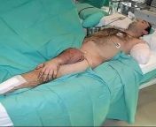 This is the case of a 26-year-old man who suffered the amputation of his left arm due to a collision between motor vehicles. The patient&#39;s arm was replanted and he developed an extensive infection requiring re-amputation, surgically transferred to thi from man who defies the world of bl eng sub
