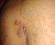 Is this HPV? What is this? 23, 6&#39;3&#34;, 300lbs, possibly diabetic, covid-19 negative, Homosexual with active sex life, I was told vy a hookup who is a doctor that I have a condyloma inside my anal canal. I need help, which kind of doctor do I go to?from serep vy mathavan