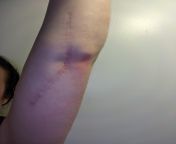 9 month post surgery scar update from nigro ka 9 inch ka land garl ki chut
