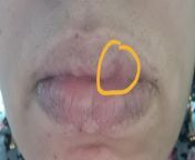 2 weeks ago I woke up feeling like something bit my lip. I still have a mark on my lip and the mark feels different. What could it be? from sunyleon lip