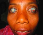 Bilateral severe corneal opacity due to measles. This 21-year-old man has no light perception. Vaccinate against measles! from due west oursex vacation 2013