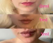 Second round of lips done, 1ml first and then another 1ml top up! Finally getting DSL! from 1ml edan96q1vlxsiwnpqae6ms swfdi 1201a
