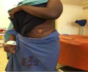 A Ugandan teenage girls colostomy, which she got due to a congenital recto-vestibular fistula. Sadly her condition led to her being shunned by others in her village. from indian teenage girl s