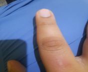 Callus on index finger has been there around 5 years from callus