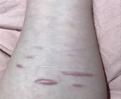 how long do you think it will take for these scars to fade?? all from march 2021 and i didnt get any medical attention for them (if this isnt allowed im so sorry but there&#39;s nothing fresh everything is over 1.5 yrs old) from so sorry kagna udav takra