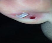 Hi so my earlobe piercing is bleeding... alOT.... it was gunk on it before so I cleaned it off and now it’s bleeding like Bloody Mary, what do I do? TW: BLOOD?? from www xxx girls whispar bleeding dilevery vaginal pussy comার