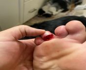 Lesser toe laceration. Sliced on my shower door track. Sliced it in half from nail to nail. Doc at Walk-in clinic sutured and sent me on my way. from nude in clinic