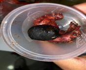 Cholelithiasis,a.k.a gall bladder stones. The whole gall bladder was obtained from my friend&#39;s father, the black one is the largest stone. from gala gall