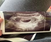 Im so confused, I thought I was 7 weeks but ultrasound tech said the baby is the size of what a 5 week ultrasound would be. from abdominal ultrasound