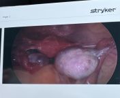 Dermoid cyst removed from inside ovary from wwwgggxxx vibeos ovary