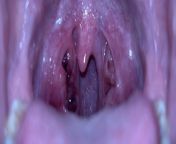 Dark red areas on right tonsil with light bleeding (never experienced) from indian red areas inside