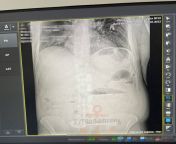 A Russian man in Ukraine inserted a spoon into his passage. He was evaluated by medical staff and it was later removed after complex surgery. It happened in Odessa after a sex game experience went south. from after hindi sex