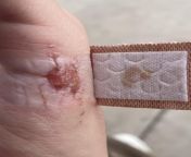 Does this look infected? It’s 3 days old,m. White around is just from bandage. from 天博综合体育在线登录▌网站ag208 cc▌⅗≒• oldm