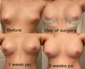 Breast Augmentation 310cc submuscular 3 weeks progress (no more weird tits Im cryign c:) from weird tits