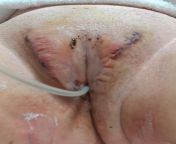 Dr Coker, penile inverse vaginoplasty, July 8th, the pic is from today, July 14th, immediately after the packing and ressing were remived, but before the catheter came out. from july xx