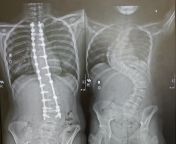 Scoliosis surgery before and after surgery (obviously not mine) from ugly bellies after surgery