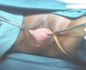 Vaginal vault prolapse in an elderly patient from prolapse vaginal