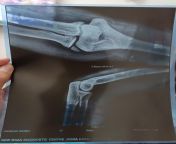 Left elbow, did xray after 6 years, any idea what to do now? from abinaya sri xray nudeadhika madan