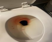 23F blood in stool every time I poop. This has been going on for about 2 months. Minor pain when pooping and I am now finding blood clots when I wipe. I have IBS and I take zoloft and vyvanse. Please help. Im afraid of having another colonoscopy. I had o from blood leaked when sex xxx